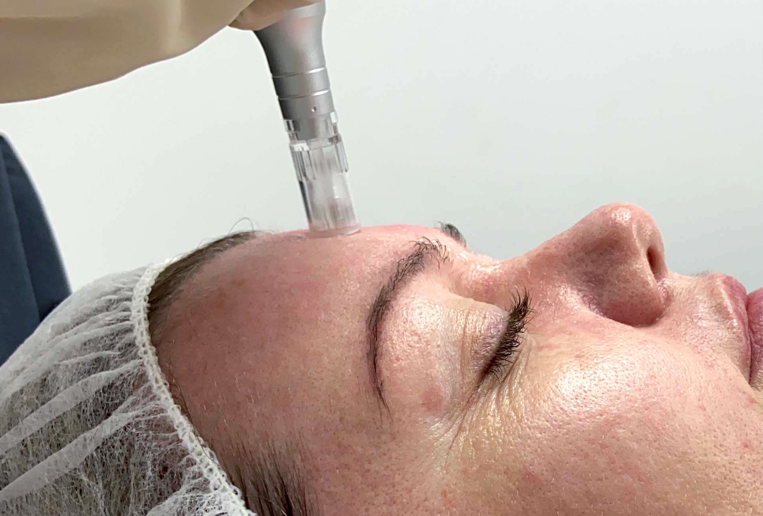 Resurfacing Results For Scarring