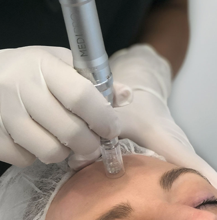 Skin Needling Full Face