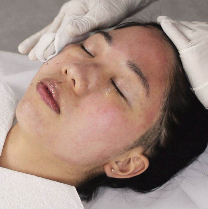 Chemical Peel - Acne Peel