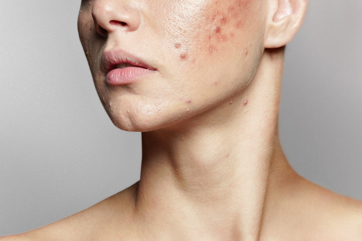Managing Adult Acne: Causes, Treatments, and Prevention
