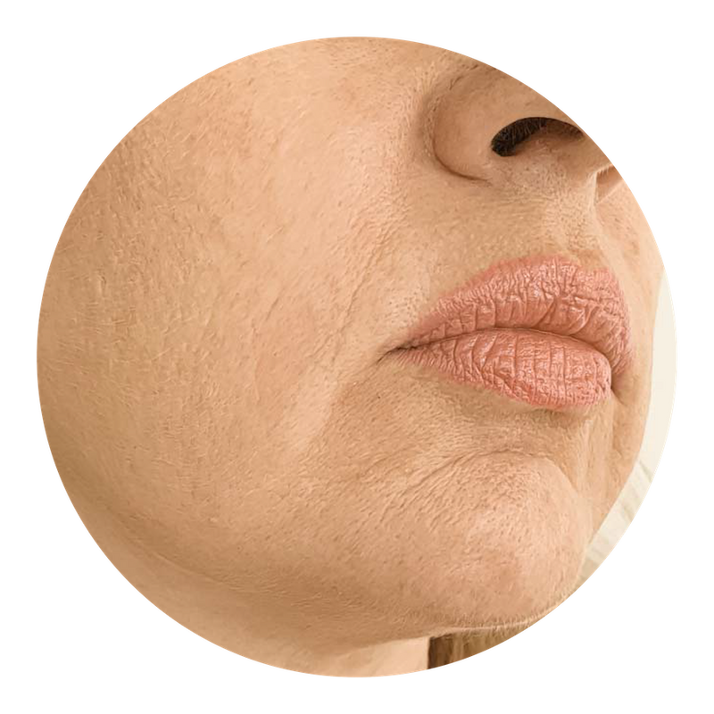 Fine Lines and Wrinkles - Causes, Types & Skincare Solutions