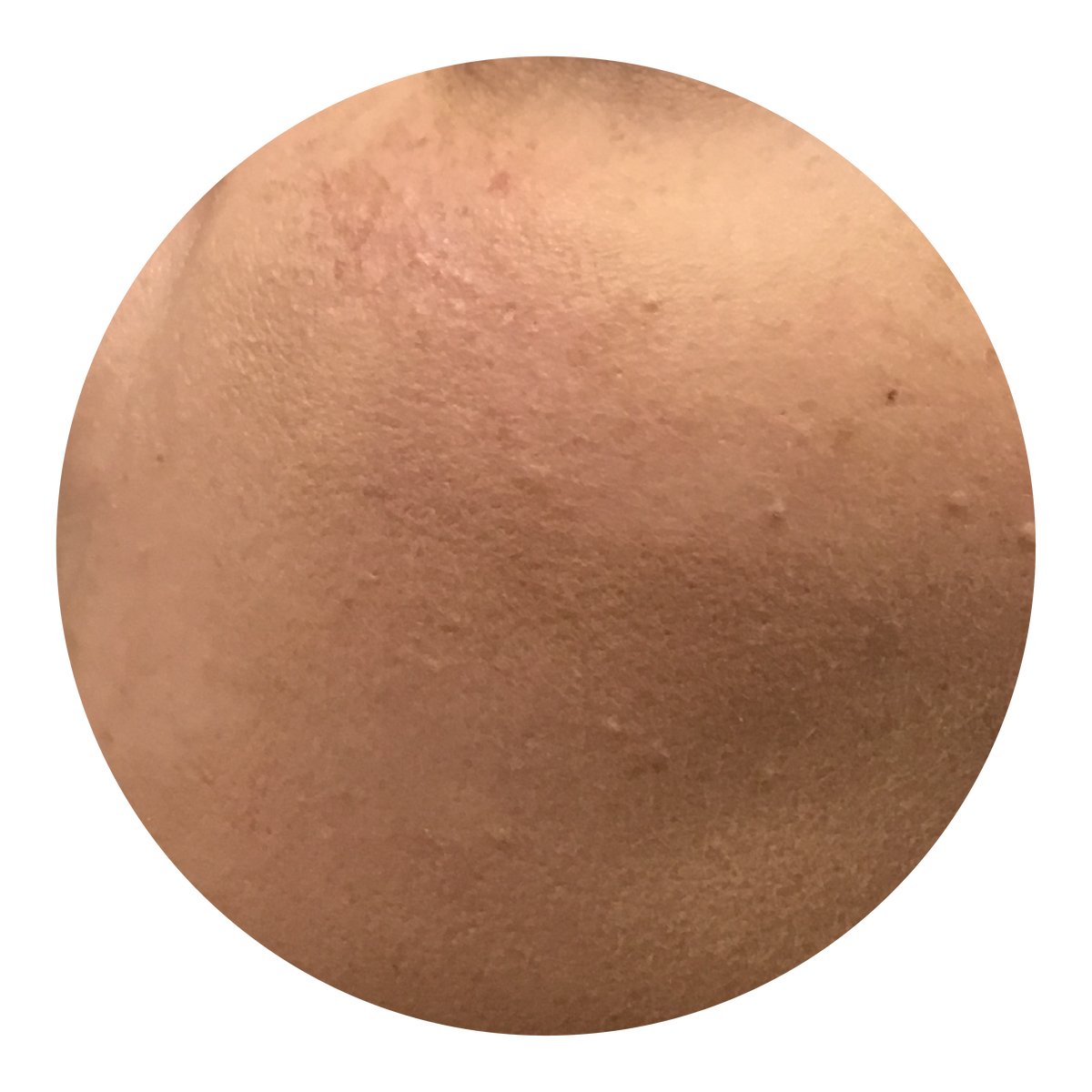 Dull and Lacklustre Skin - Causes, Types & Skincare Solutions