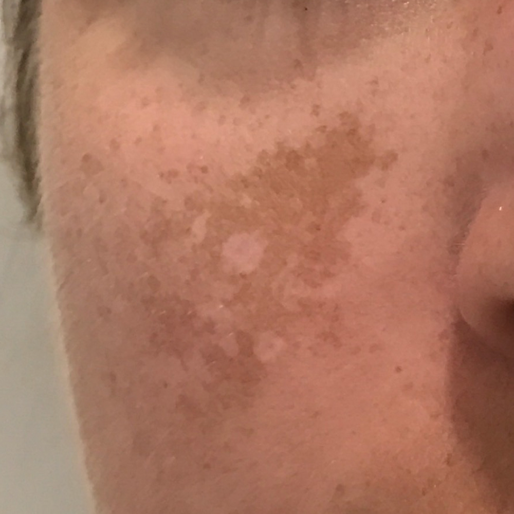 Close-up of facial skin with brown sunspots and uneven pigmentation