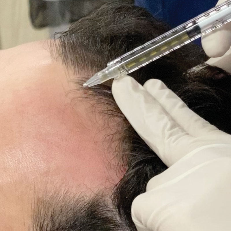 Mens Hair Regrowth Therapy Consultation
