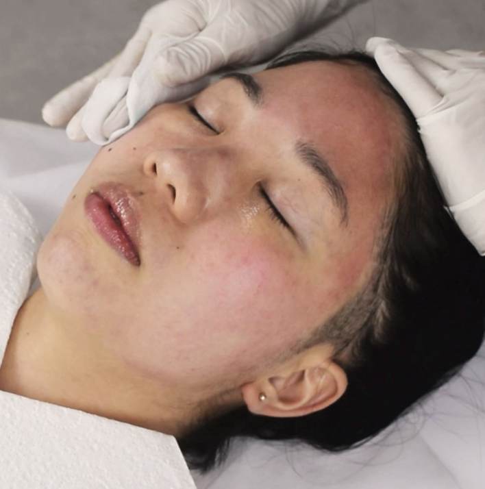 Chemical Peel - Acne Peel + LED Light Therapy